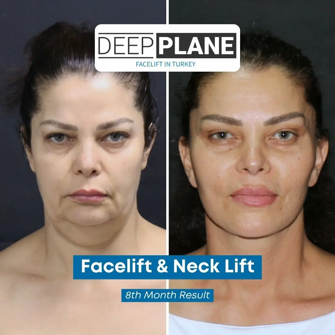 Facelift Turkey Before and After Photos