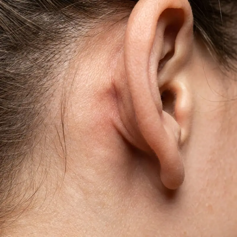Close-up of healed deep plane facelift incision hidden naturally in the post-auricular crease behind the ear.