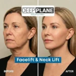 Facelift and necklift surgery before and after results in Turkey showing lower face and neck rejuvenation
