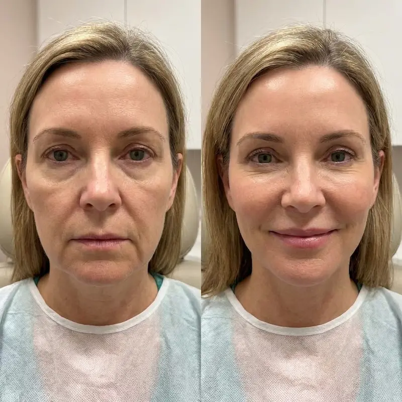 Twilight Facelift before and after results in Turkey performed under IV sedation showing natural facial rejuvenation